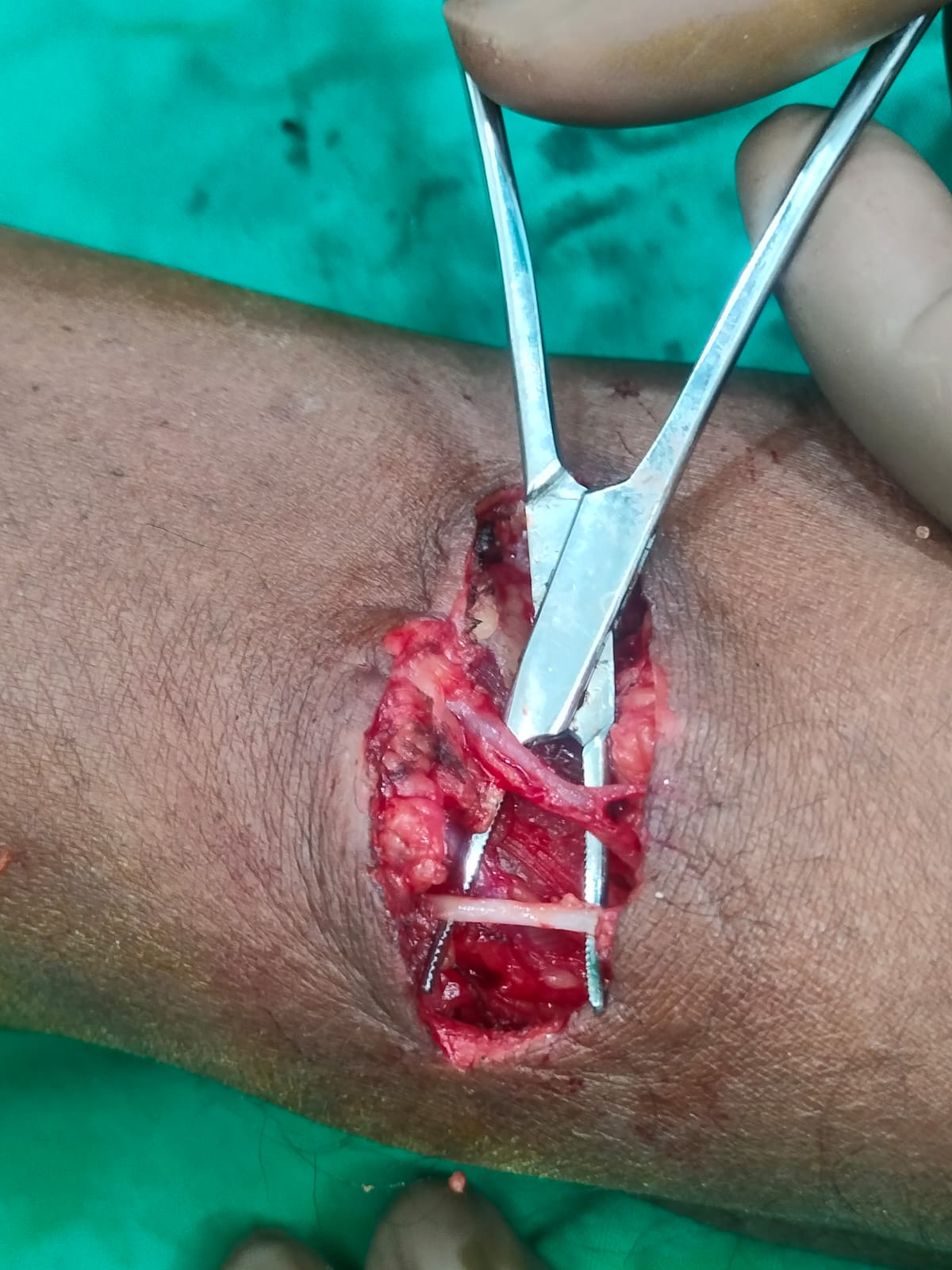 AV Fistula for Dialysis